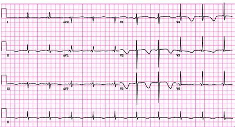 Initial Ecg Shows Sinus Rhythm With Deep T Wave Inversion And