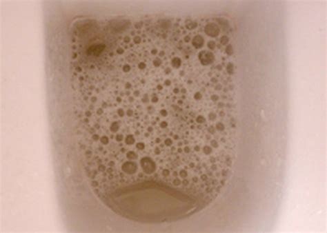 Foamy Urine Causes Treatment Hubpages