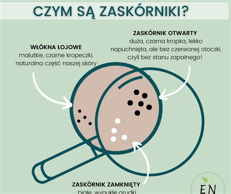 Czym Są Zaskórniki I Jak Sobie Z Nimi Poradzić Naturalne Kosmetyki Od Farmaceutów Bioherba