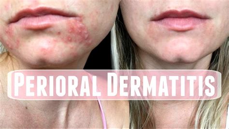 Perioral Dermatitis How I Treated It Youtube