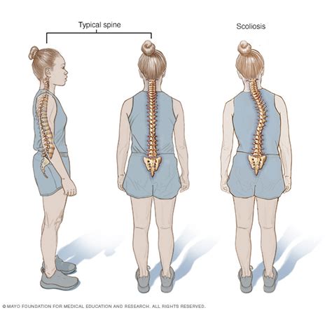 Scoliosis Disease Reference Guide