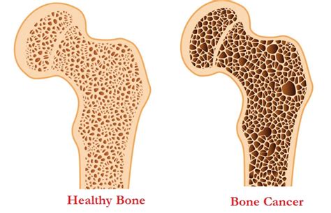 Bone Cancer Causes Symptoms Stages Types Signs Treatment Prognosis Healthmd