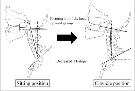 Comparison Of Sagittal Occipito Cervical Parameters Measured On Sitting