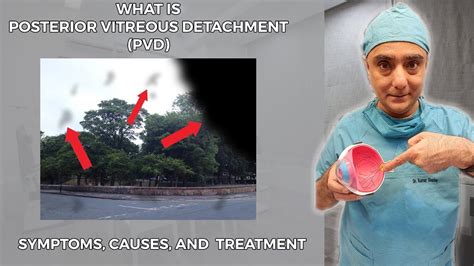 What Is Posterior Vitreous Detachment Pvd Symptoms Causes And
