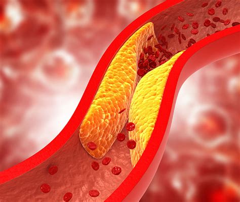 Peripheral Arterial Disease Medical Management Pelajaran