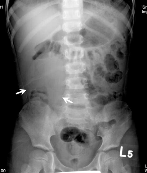 Ovarian Torsion Caused By Teratoma Masquerading As Perforated
