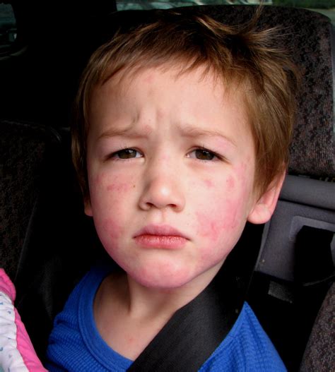 Allergic Reaction Kris Pix Flickr