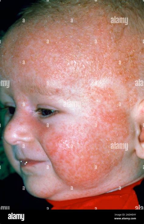 Eczema An Eczema Rash Covering Most Of The Skin On A Babys Face And