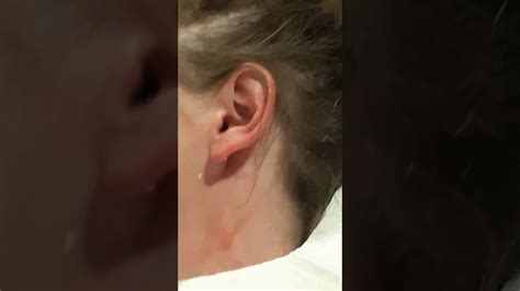 Huge Cyst Popping On Ear Youtube