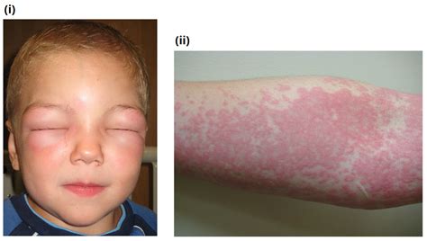 Severe anaphylactic reactions outside hospital: Anaphylaxis - Clinical Features - Management - TeachMeSurgery