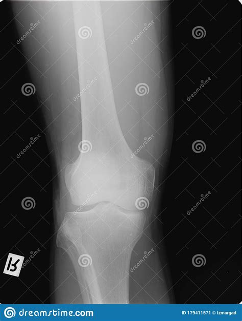 X Ray Scan Of A Right Knee Stock Image Image Of Bone 179411571