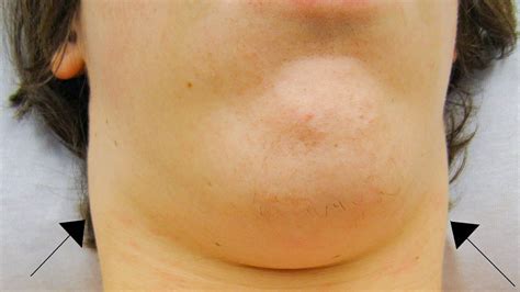 Are Swollen Lymph Nodes Under The Jaw A Sign Of Covid 19