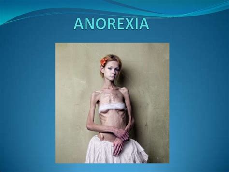 Caracteristicas De La Anorexia Causas De Anorexia Anorexia En Hombres