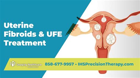 Uterine Fibroids And Ufe Treatment Imaging Healthcare Specialists Youtube