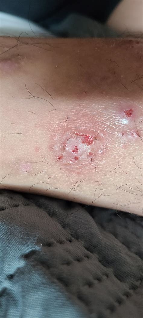 Any Ideas I Have Several On My Leg And It Scabs Over But Never Heals