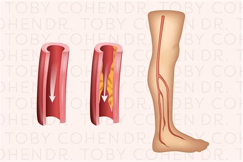Peripheral Artery Disease Dr Toby Cohen