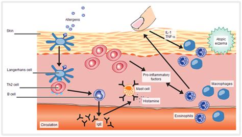 Pathophysiology Of Atopic Dermatitis