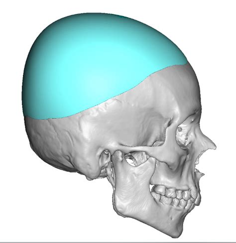 Plastic Surgery Case Study The Two Stage Large Skull Implant
