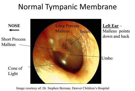 Normal Tympanic Membrane Critical Care Practitioner