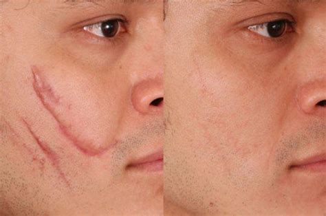 Laser Scar Removal Melbourne Como Curar Cicatrices Eliminar