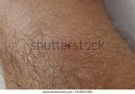 Infected Tick Bite On Human Skin Stock Photo 1418392382 Shutterstock