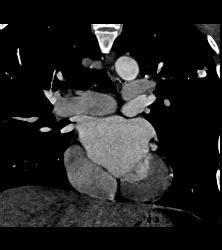 Tuberculoma In Left Upper Lung Simulates A Pulmonary Arteriovenous