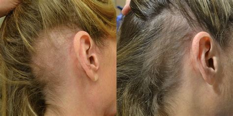 Platelet Rich Plasma Prp Before And After Photos Hair Restoration Of The South New Orleans La