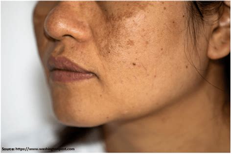 Post Inflammatory Hyperpigmentation The Skin Shape Clinic