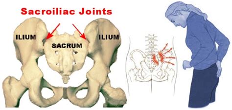 Sacroiliac Joint Pain Symptoms Signs And Treatment