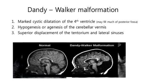 Dandy Walker Malformation Posterior Fossa Radiology Schools