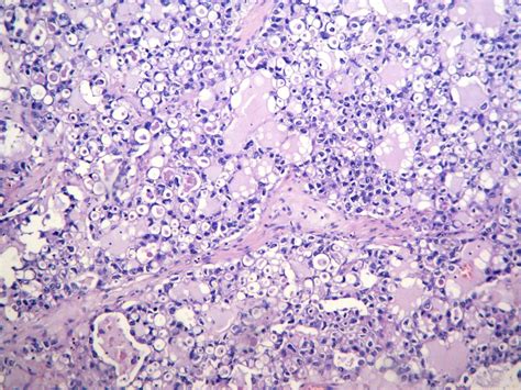 Pathology Outlines Clear Cell Carcinoma