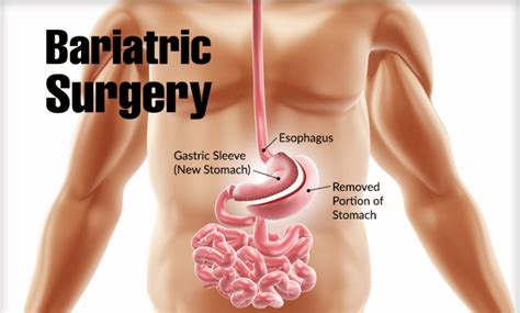 Bariatric Surgery Types Risks Recovery Sutured