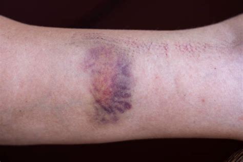 Hematoma Arm Stock Photos Pictures And Royalty Free Images Istock