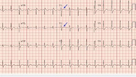 Reciprocal st depression and pr elevation in avr and v1; Electrocardiogram revealing type 2 Brugada pattern showing ...
