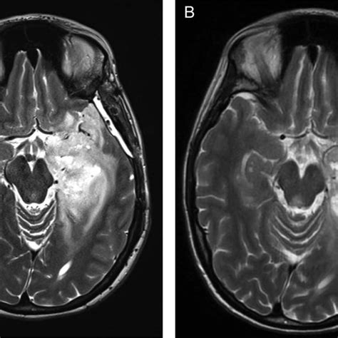 Multiple White Matter Lesions Axial T2 And T1 Postgadolinium Mri A