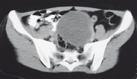 Ct Scan Showing A Large Left Ovarian Cyst Open I