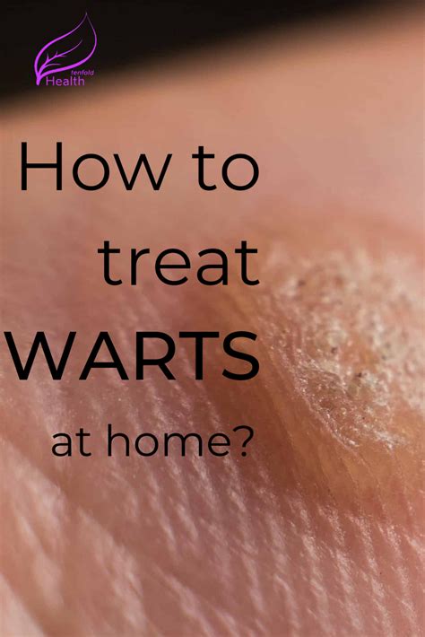 How To Get Rid Of Warts How To Treat Warts Warts Warts Remedy