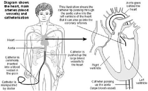 Cardiac Catherization And Coronary Angiography Glendale Heart