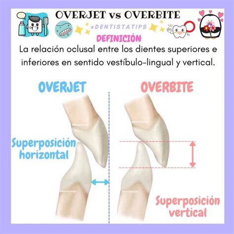 Overjet y Overbite Odontología Escuela de higiene dental Anatomía