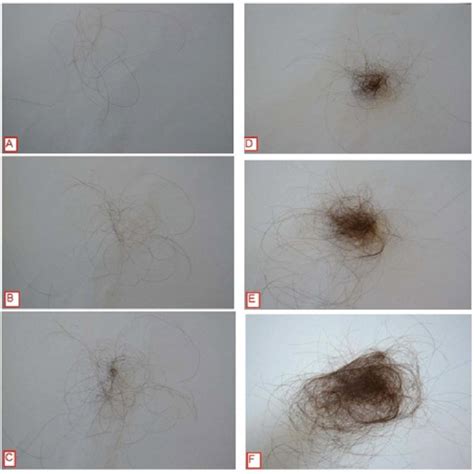 Sinclair Scale For Assessment Of Mid Frontal Scalp Hair Density 17