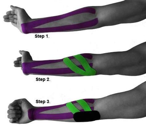 Kinesiology tape for your golfer's elbow may be one option that your physical therapist uses to treat your condition. 1000+ images about Cubital Tunnel Syndrome on Pinterest ...