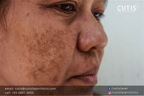 Common Questions About Melasma Answered Laser Clinics Singapore
