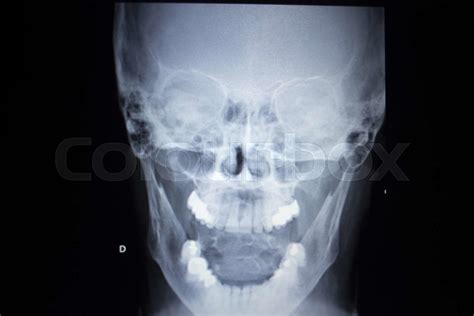 X Ray Orthopedics Traumatology Scan Nose Injury Breathing Stock Image