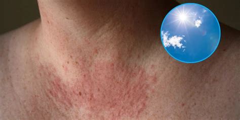 Alergia Al Sol Los Síntomas Y Cómo Debes Cuidar Tu Piel