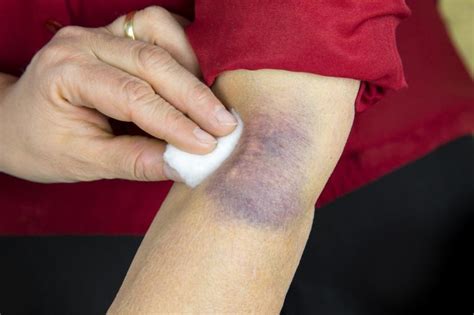 Bruise Types Symptoms Causes Prevention And Treatment