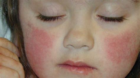Swollen Cheeks Causes Red In Toddler And Inside Mouth American Celiac