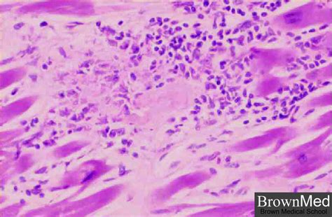 Myokarditiden sind entzündliche erkrankungen des herzmuskels mit vielfältigen infektiösen und nichtinfektiösen ursachen myocarditis — early biopsy allows for tailored regenerative treatment. Myocarditis - AIDS