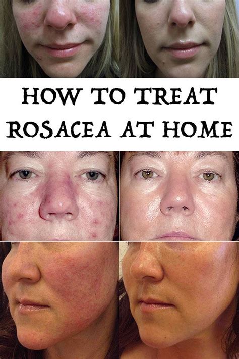How To Treat Rosacea At Home Timeless Beauty Tricks How To Treat