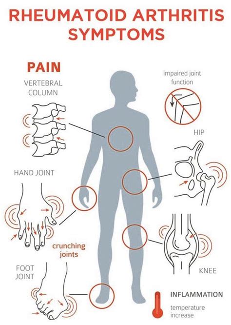 Rheumatoid Arthritis Flare Ups Management