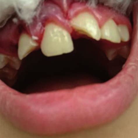 Types Of Dental Trauma Crown Root Fracture With Pulp Involvement